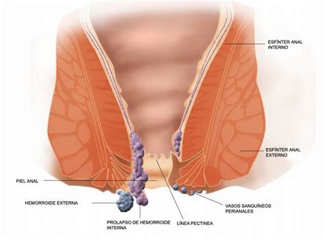 Maybe you would like to learn more about one of these? Las hemorroides