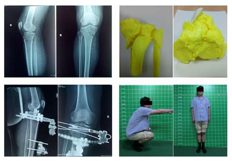 3D Printing Medical Models for Preoperative Planning in ...