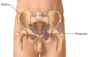 Pelvic fracture is a disruption of the bony structures of the pelvis, including pelvic ring fractures, acetabular fractures, and avulsion fractures. Pelvic Fracture - STAR Physical Therapy | Tennessee | TN