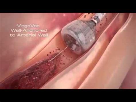 Do not leave your home, except to get medical care. Removing Blood Clot From the Artery or Veins - YouTube