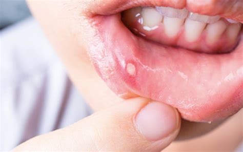 Ada beberapa kajian perubatan menyatakan tekanan atau kecederaan adalah antara sebab berlaku ulser. Ulser Mulut Yang Sungguh Memedihkan