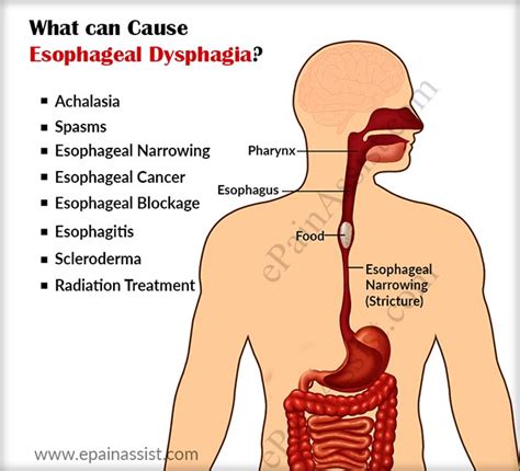 (v) to swallow food or liquid quickly. What Causes Dysphagia and How is it Diagnosed and Treated?