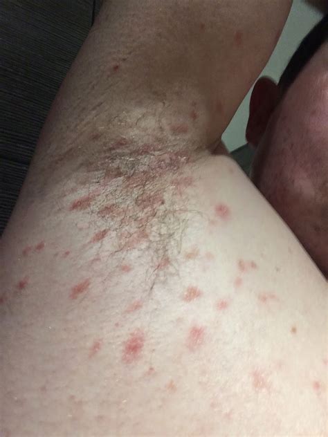 Pityriasis rubra pilaris refers to a group of chronic disorders characterized by reddish orange, scaling plaques and keratotic follicular papules. My pityriasis rubra pilaris blog: February 2015