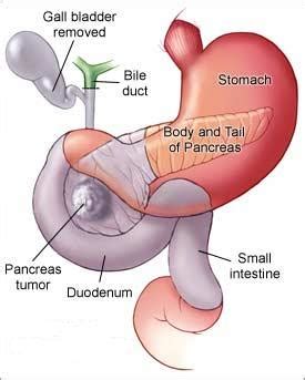 Pancreatic cancer is a disease in which malignant (cancerous) cells form in the tissues of the pancreas.the pancreas is a gland located behind the stomach and in front of the spine.the pancreas. العلامات المبكرة لسرطان البنكرياس