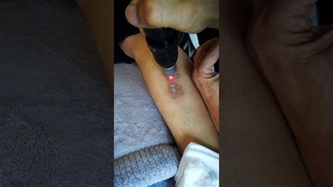 There is another method of. PicoSure tattoo removal - YouTube