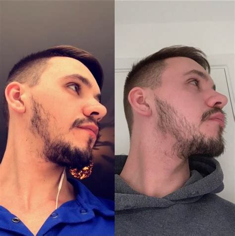 After one year of treatment, the average number of hairs in the observed area increased by 112 hairs. Minoxidil Before And After Beard Result : The Struggle to ...