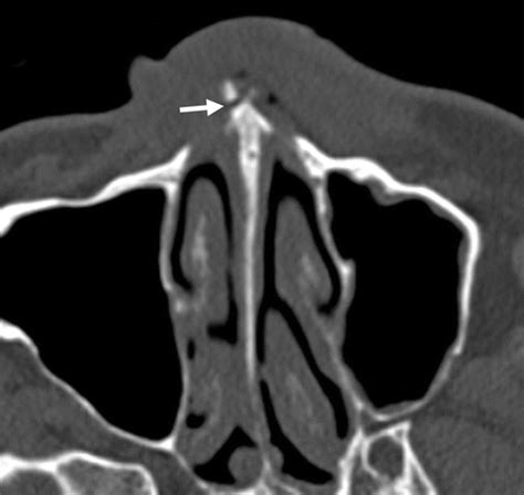 Multidetector CT of Midfacial Fractures: Classification ...