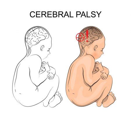 Spastic cerebral palsy, sometimes called pyramidal cerebral palsy, affects more than 70 percent of cerebral palsy patients and is the most common those with spastic cerebral palsy are hypertonic with stiff, tight muscles which cannot relax in some parts of their body. YAYASAN PEDULI CEREBRAL PALSY SURABAYA - Karena Kami Peduli