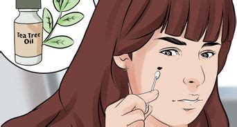 Ridding yourself of pilonidal disease may be a multistep process. 3 Ways to Treat a Pilonidal Cyst - wikiHow