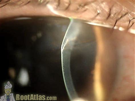 The background illumination is required if the view through the slit lamp is to be. Ophthalmology - corneal laceration | This slit-lamp ...