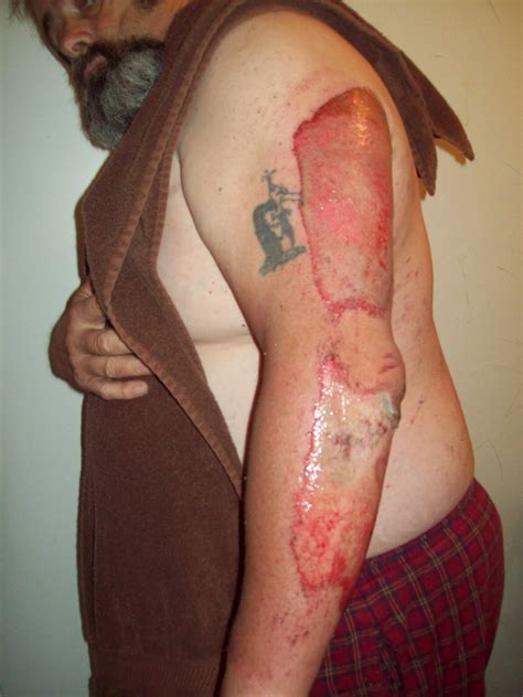 Road rash is a fairly inevitable part of biking. NORTH TEXAS BIKERS V: MY MOTORCYCLE, S.O., KIA, RIP 6-30-2011