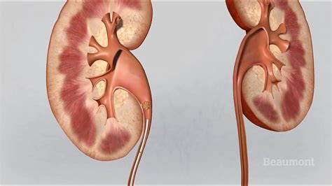 May 06, 2019 · symptoms of kidney stones. How To Know If I Have Kidney Stones