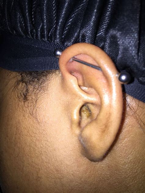 Half of the infection is due to the transfer of bacteria from your hands. I've had my industrial piercing for around 2 months now ...