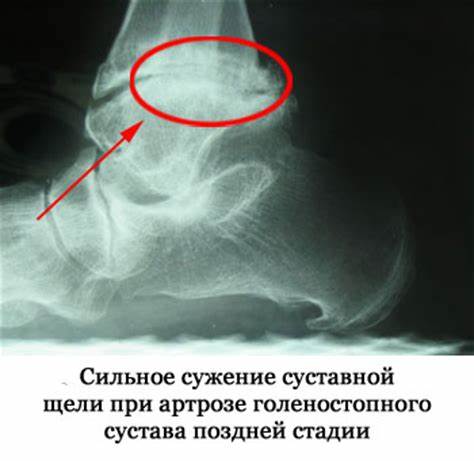 Артроз голеностопного сустава диета Артроз голеностопного сустава: симптомы и лечение, причины, стадии болезни Артроз голеностопного сустава: симптомы и лечение, причины, стадии болезни Артроз голеностопного сустава диета