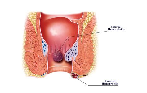 The acute management of haemorrhoids. Hemorrhoids can make sex painful. Hemorrhoids can make sex painful.