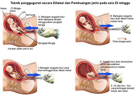 Kehadiran fibroid besar di dalam dan sekitar rahim dapat membuat hubungan seksual sangat menyakitkan bagi seorang wanita. Buih-buih laut dalam: Abortion baby