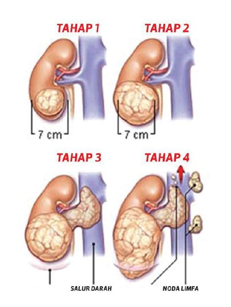 Paling sering rasa nyeri itu disebabkan oleh cedera otot atau sendi di area sakit pinggang yang terkait dengan adanya kanker lebih mungkin disebabkan oleh keberadaan tumor di daerah sekitar pinggang, seperti usus besar. Kanser Buah Pinggang : Lelaki Lebih Berisiko