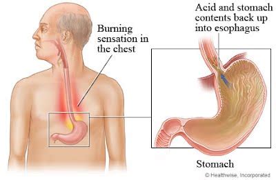 Saat menderita penyakit gastritis atau mag, anda pun dapat merasakan keluhan ini. Kalau Alami Masalah Ini Pada Perut Korang, Mungkin Petanda ...