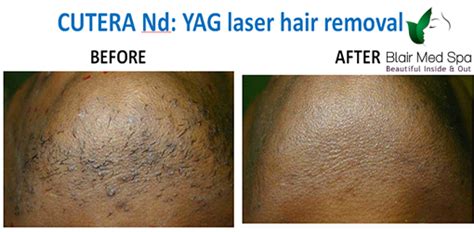 Hair follicles are targeted during the treatment and the power of the treatment is modified to the patient's comfort. Laser Hair Removal - Laser Hair Removal Houston | Laser ...