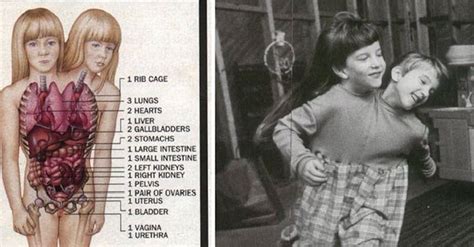They have one body, share a pair of limbs, with two heads, two pairs of eyes, two necks, with separate vital organs such as two hearts, three kidneys, two spines joined at the pelvic region and four lungs but share. Things Most People Don't Know About Conjoined Sisters Abby And Brittany