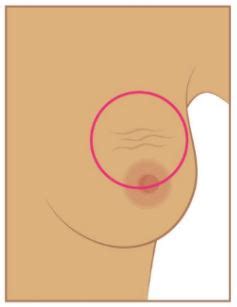 Ces cellules cancéreuses, appelées des métastases, touchent généralement les os, mais peuvent aussi se propager dans des organes vitaux tels que les poumons. Le cancer du sein : quels signes d'alerte