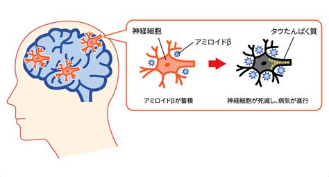 原作：浅名ゆうな / 漫画：斯波浅人 / キャラクター原案：花ヶ田 キーワード: アルツハイマー型認知症 (あるつはいまーがたにんちしょう ...