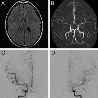 There are differences in other clinical symptoms experienced by patients that can be used to help clarify whether a person has narcolepsy or ih. (PDF) Narcolepsy-like excessive daytime sleepiness associated with moyamoya disease: case report