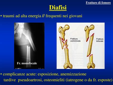 PPT - Fratture dell'arto inferiore PowerPoint Presentation ...