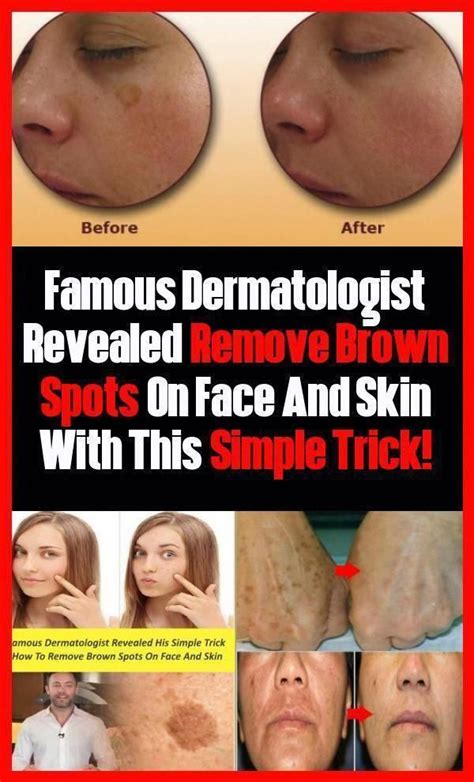 How to basics face reveal video of proof: Revealed famous dermatologist: Remove brown spots On Face And Skin With this simple trick! # ...