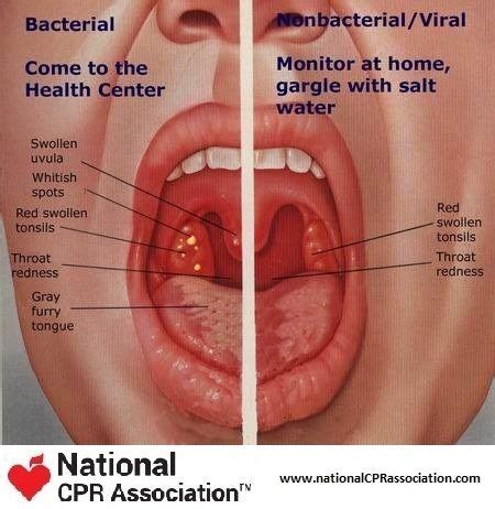 After a tonsillectomy, it is normal for the tonsil beds to look like they are covered with a white or yellow film. Photos from posts | Treatment for sore throat, Nursing ...