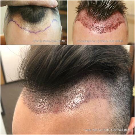 What the robot does is that it scans the. 1 WEEK POST FUE ARTAS PROCEDURE #drscottalexander # ...