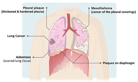 Symptoms associated with pericardial mesothelioma are: Mesothelioma - Overview of Malignant Mesothelioma Cancer