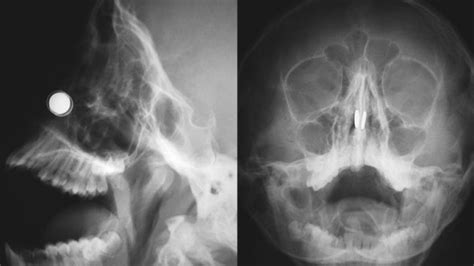 This insertion will cause a split. Foreign Bodies: Insertions