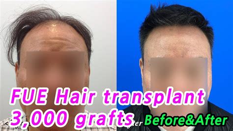 7 best clinics for hair transplant in republic of korea. FUE Hair Transplant in Korea (3,000 Grafts)_Before&After ...