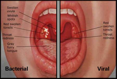 Tonsillitis and pharyngitis refer to the same type of infection. Centor Criteria Tonsillitis Throat Difference Sore Throat ...