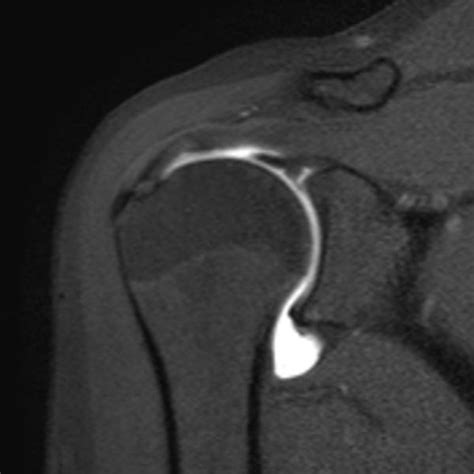 Cerebral venous sinus thrombosis, cvst. Bildergalerie | MR Institut Bludenz