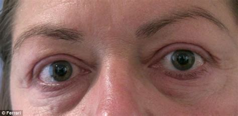 Seriously… i went several days without an urge and tonight it all came crashing down. Woman, 42, has eyelash transplant after her addiction to ...