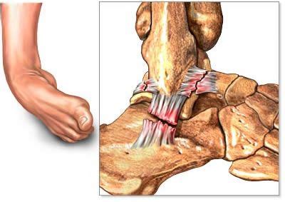 Read more about symptoms, diagnosis, treatment, complications, causes and prognosis. this image makes me nauseous | Sprained ankle, Ankle ...