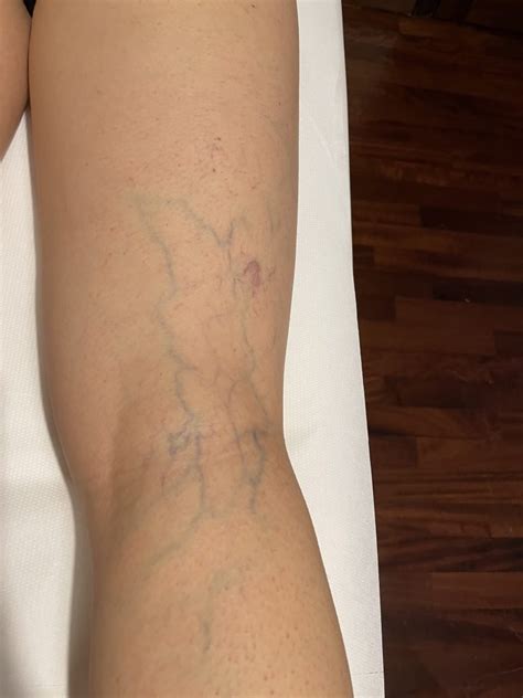 Terapia sclerosante per capillari - Studio Medico Santoro