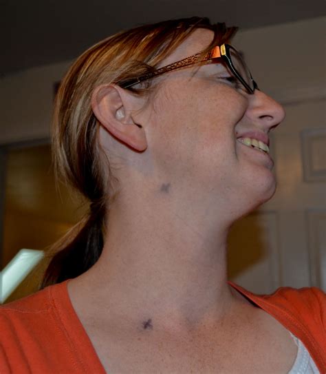 Head and neck cancer is a general term for a range of cancers that start in the tissue or lymph nodes in the head and neck area. T-Cancer: Lymph node Mapping
