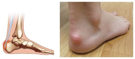 Bilateral piezogenic papules of the heel 5. Lumps and Bumps - Abingdon Footcare Practice