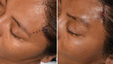 Jun 05, 2021 · cosmetic use of sutures from plastic surgery gained real traction in the late '90s and early 2000s when threads were used to suspend damaged cheek tissue and soon after that, permanent sutures were being used to help lift the face, however, the permanence served as more of a problem than a solution and it was recognized that the absorbable. » Blog ArchiveTechnical Strategies - The Pretrichial ...