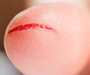 Cuts and Lacerations | Sports Injuries