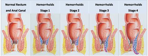 The only symptom that one can experience is bleeding when defecating. Hemorrhoids during pregnancy - causes, symptoms and ...
