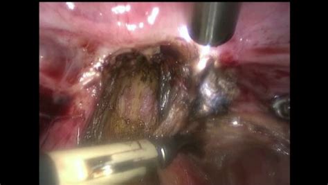 Les différentes formes d'endométriose digestive et leur traitement l'atteinte rectale est la plus fréquente des atteintes du tube digestive lors d'endométriose digestive. Chirurgie de l'endométriose rectale par shaving rectal et ...