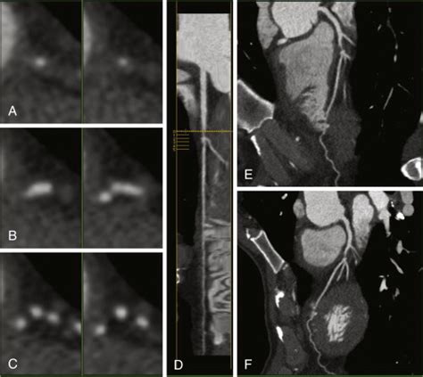 Occlusion of the arteria radialis dextra. CT Coronary Angiography | Radiology Key