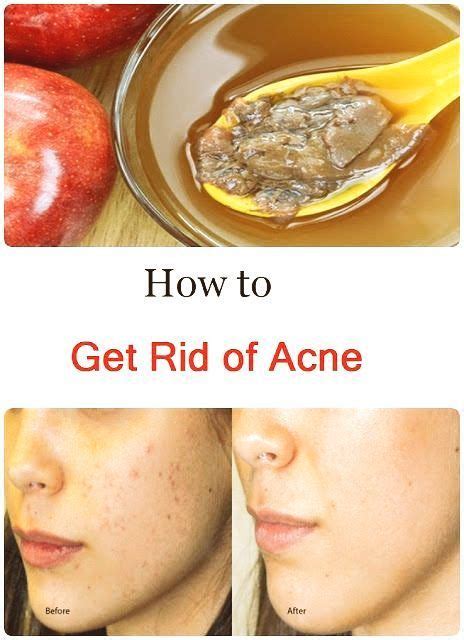 I started trying everything i could — exfoliants, citrus peels, foam cleansers, charco. How to Get Rid of Acne | Beauty tipps, Hautprobleme, Tipps