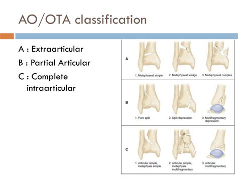 PPT - FIBULAR FIXATION IN Pilon F RACTURE PowerPoint ...