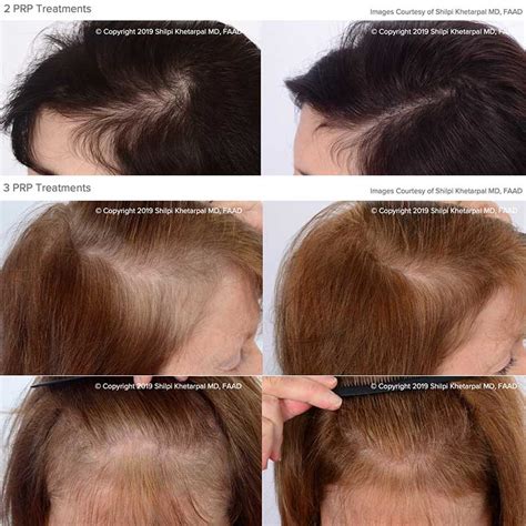 Though there is a bit of a mystery surrounding how rogaine actually works, what is clear is that minoxidil causes the hair to grow back. PRP Hair Restoration to Regrow Your Hair • JC Total Health