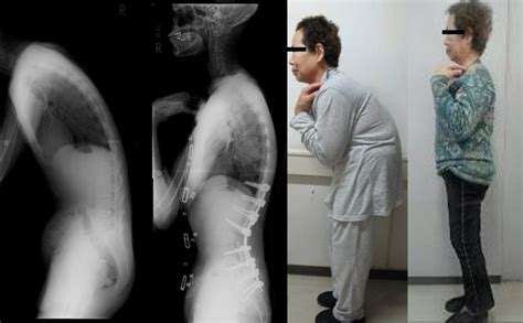 成人脊柱変形 （脊柱後弯症、後側弯症など） | 東京医科歯科 ...